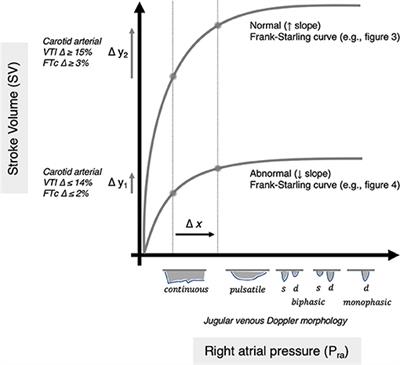 Inferring the Frank–Starling Curve From Simultaneous Venous and Arterial Doppler: Measurements From a Wireless, Wearable Ultrasound Patch